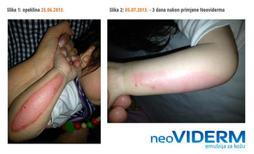 Neoviderm emulzija za kožu, 100 ml - Vitashop